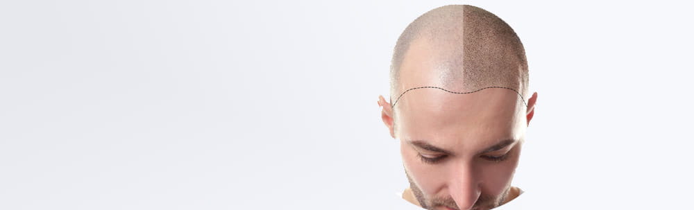 hair transplant in delhi